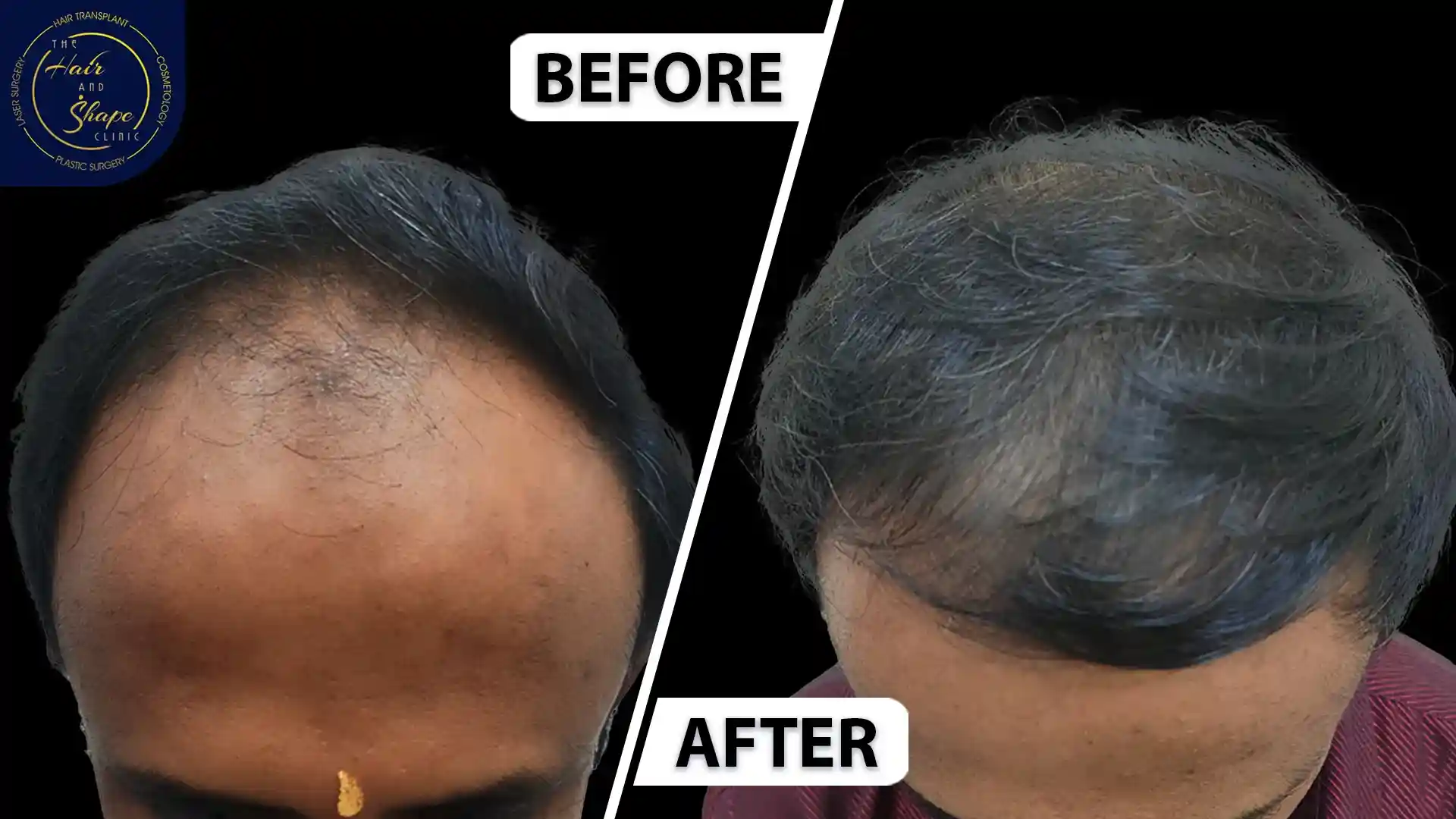 PRP Treatment result2